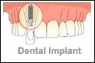 Oakville Dental Implants