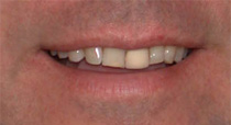 Oakville Dental Implants