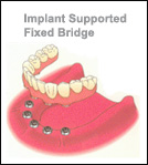 Oakville Dental Implants