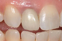 Oakville Dental Implants