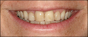 Oakville Dental Veneers