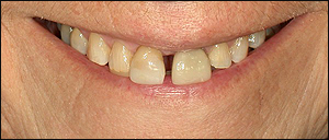 Oakville Dental Crowns